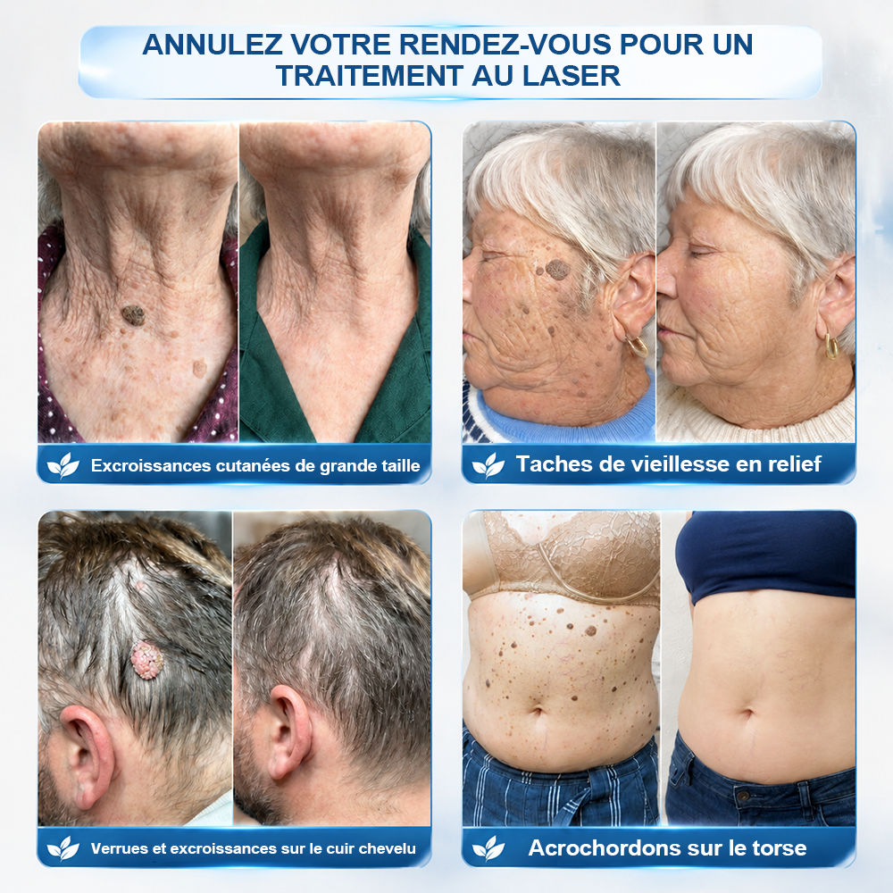 🏆 Boutique Officielle | ✅💎 Creawel® Effaceur de Marques & Imperfections en 7 Jours ✨ (Roll-On Sans Douleur, Sans Cicatrices)