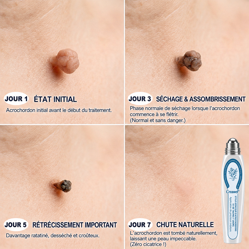 🏆 Boutique Officielle | ✅💎 Creawel® Effaceur de Marques & Imperfections en 7 Jours ✨ (Roll-On Sans Douleur, Sans Cicatrices)