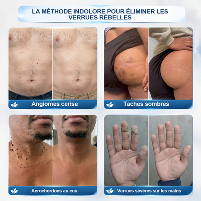 🏆 Boutique Officielle | ✅💎 Creawel® Effaceur de Marques & Imperfections en 7 Jours ✨ (Roll-On Sans Douleur, Sans Cicatrices)
